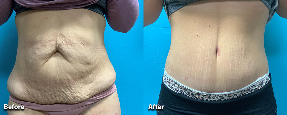 Tummy Tuck Procedure